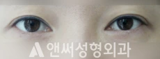 Answer Plastic Surgery case 120: Before