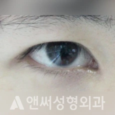 Answer Plastic Surgery case 118: Before