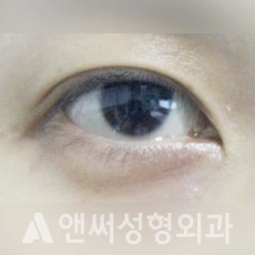 Answer Plastic Surgery case 117: Before