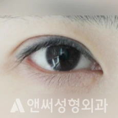 Answer Plastic Surgery case 116: Before