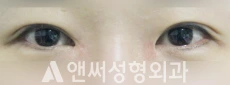 Answer Plastic Surgery case 115: Before