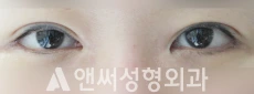 Answer Plastic Surgery case 115: After