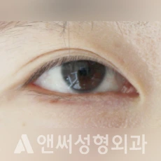 Answer Plastic Surgery case 114: Before