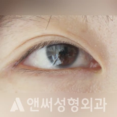 Answer Plastic Surgery case 114: After