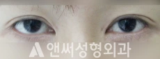 Answer Plastic Surgery case 113: Before