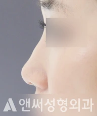 Answer Plastic Surgery case 112: Before