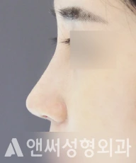 Answer Plastic Surgery case 112: After