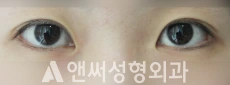 Answer Plastic Surgery case 111: Before