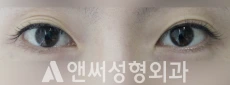 Answer Plastic Surgery case 110: Before