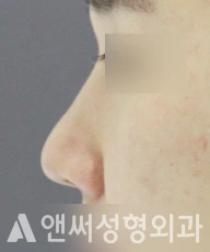 Answer Plastic Surgery case 109: Before