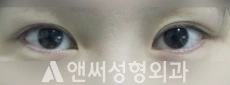 Answer Plastic Surgery case 108: Before