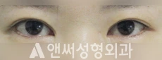 Answer Plastic Surgery case 107: Before