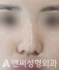 Answer Plastic Surgery case 106: Before