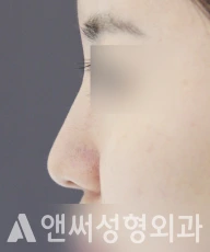Answer Plastic Surgery case 105: Before