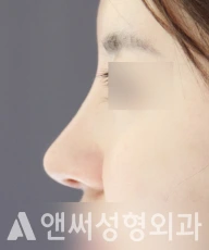 Answer Plastic Surgery case 105: After