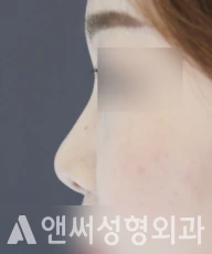 Answer Plastic Surgery case 100: Before