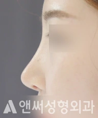 Answer Plastic Surgery case 100: After