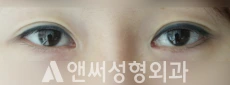 Answer Plastic Surgery case 98: Before