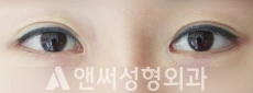 Answer Plastic Surgery case 98: After