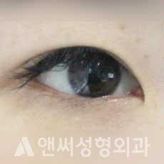Answer Plastic Surgery case 97: Before