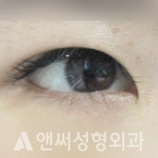 Answer Plastic Surgery case 97: After