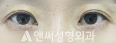 Answer Plastic Surgery case 96: Before