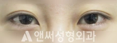 Answer Plastic Surgery case 95: Before