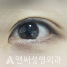 Answer Plastic Surgery case 94: Before