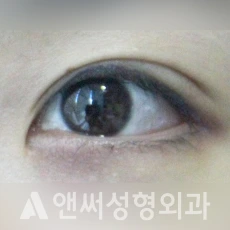 Answer Plastic Surgery case 94: After