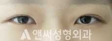 Answer Plastic Surgery case 92: Before
