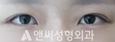 Answer Plastic Surgery case 92: After