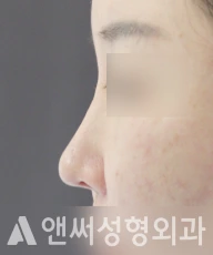 Answer Plastic Surgery case 91: Before