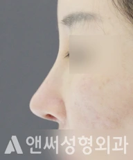Answer Plastic Surgery case 91: After