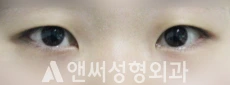 Answer Plastic Surgery case 90: Before