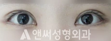 Answer Plastic Surgery case 90: After