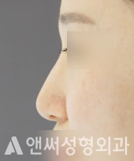 Answer Plastic Surgery case 87: Before