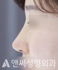 Answer Plastic Surgery case 87: After