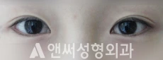 Answer Plastic Surgery case 86: Before