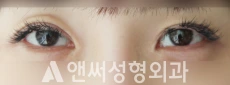 Answer Plastic Surgery case 85: Before