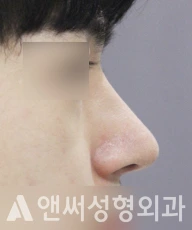 Answer Plastic Surgery case 84: After