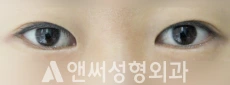 Answer Plastic Surgery case 83: Before