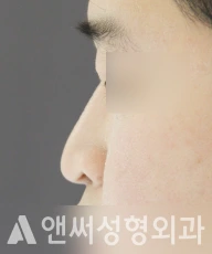 Answer Plastic Surgery case 82: Before