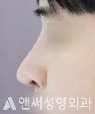 Answer Plastic Surgery case 82: After