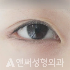 Answer Plastic Surgery case 81: Before