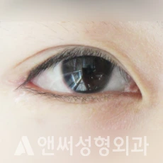 Answer Plastic Surgery case 81: After