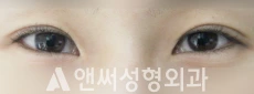 Answer Plastic Surgery case 80: Before