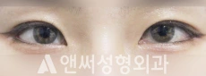 Answer Plastic Surgery case 80: After