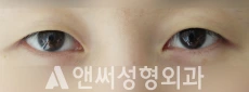 Answer Plastic Surgery case 75: Before