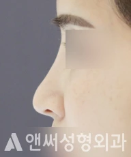 Answer Plastic Surgery case 74: Before