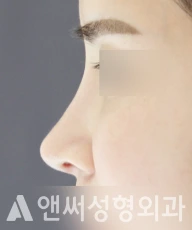 Answer Plastic Surgery case 74: After
